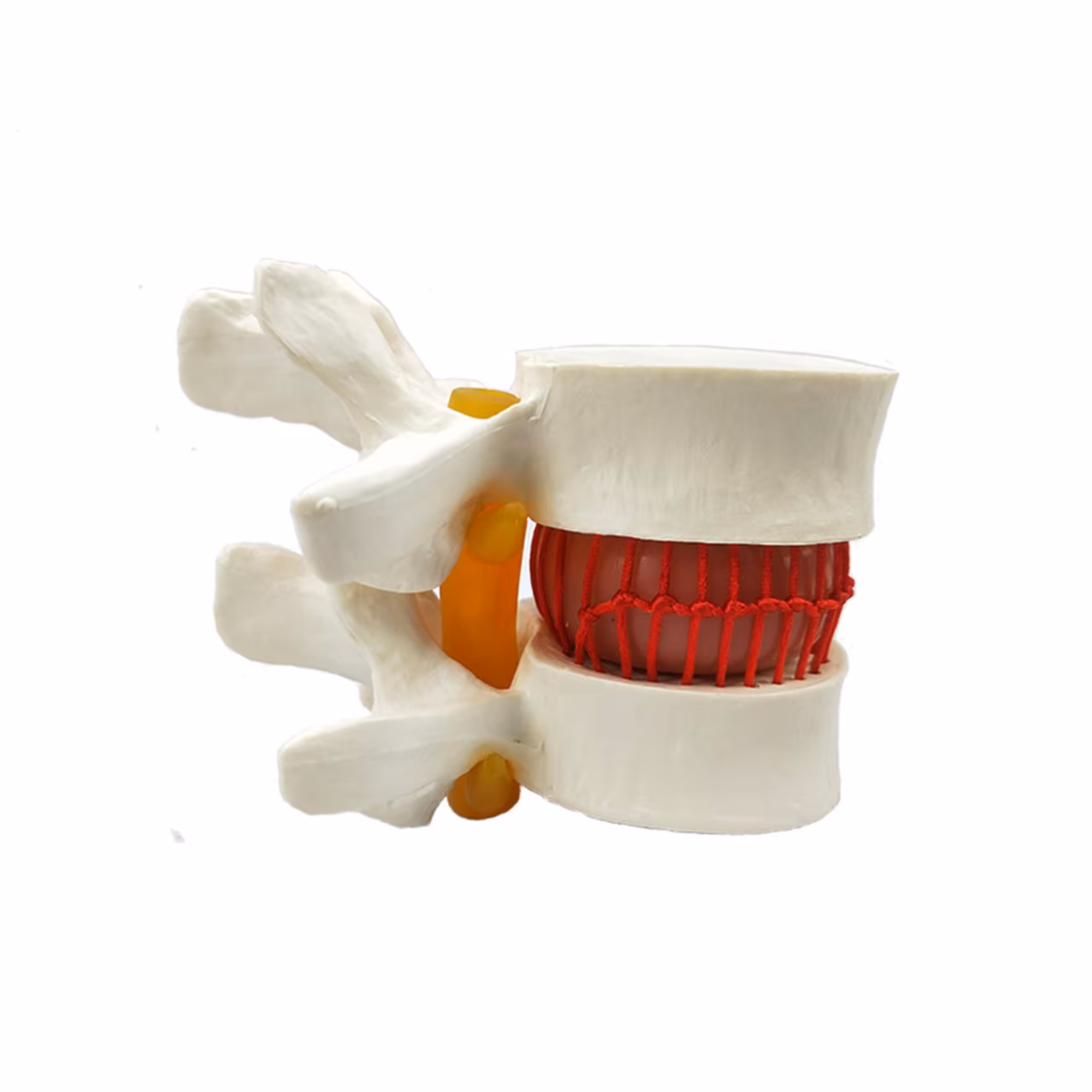 Disk Hernisi Fıtık Maketi Model 2